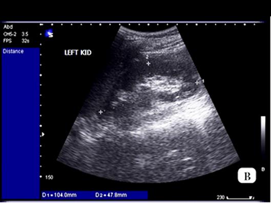 Ultrasonography And Ct Guided Percutaneous Renal Biopsy In Diagnosis Of